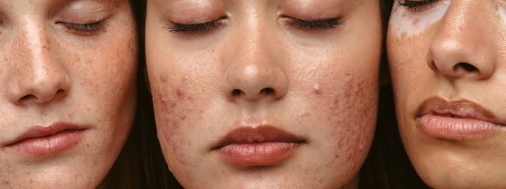 Mulher com pele saudável após tratamento de acne